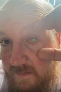 Man shows how he used woman’s placenta to recover his lost sight